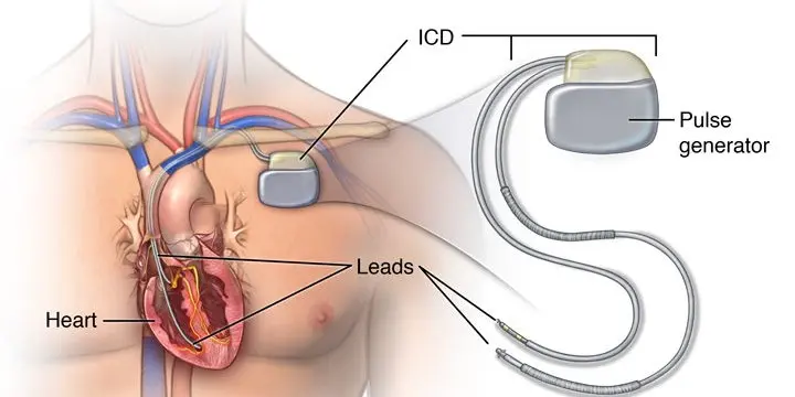 سعر جهاز تنظيم ضربات القلب ICD في مصر 