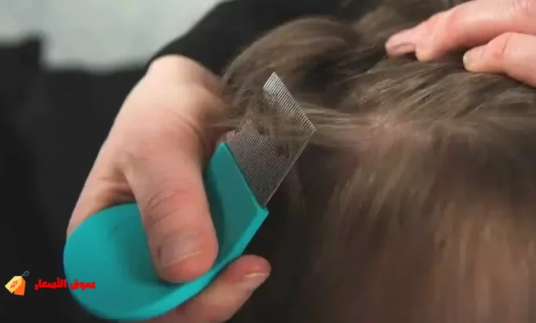 لماذا يفشل علاج القمل في المنزل